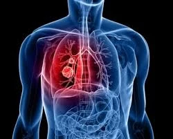 Καρκίνος του Πνεύμονα: Μην αγνοείς τα συμπτώματα – Η έγκαιρη διάγνωση σώζει ζωές